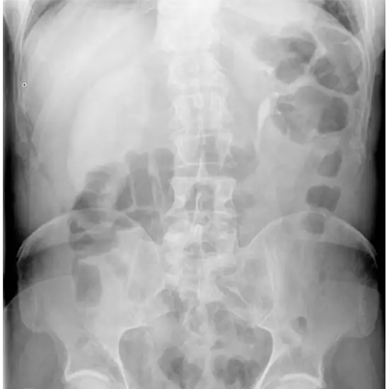x-ray nephrogram